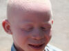 423px-Albinisitic_man_portrait.jpg