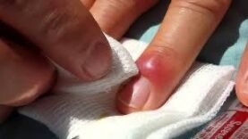 Panaris, infection bactérienne ou pratique occulte ?