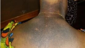 La dépigmentation : un enjeu de santé publique aux répercussions alarmantes – Découvrez les vérités cachées !