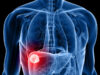 cancer-du-foie.jpg