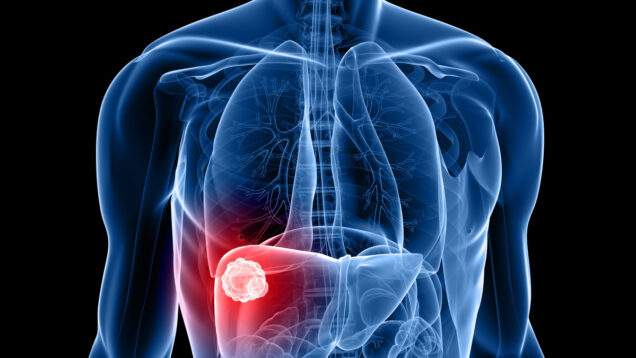 cancer-du-foie.jpg