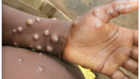 Fin de l&rsquo;urgence sanitaire mpox : un cap franchi par le CDC Afrique