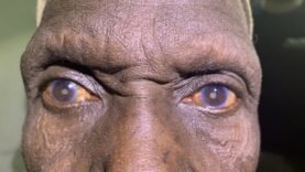 Soins gratuits pour la cataracte : une initiative solidaire au CHU de l&rsquo;Amitié Tchad-Chine du 4 au 9 avril